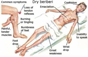 Lista de sintomas de beri beri